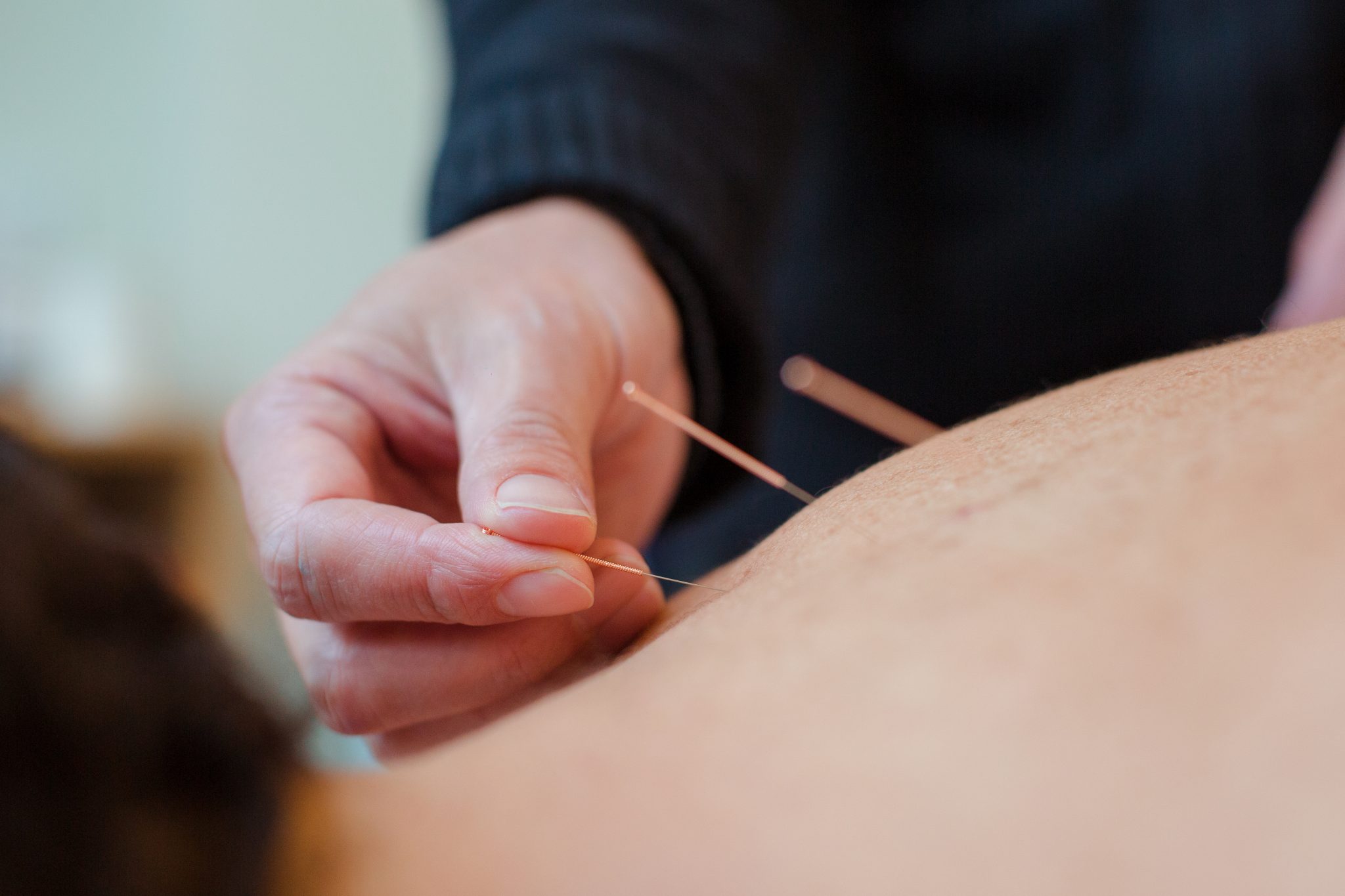 Acupuncture At Selph Health Studios Rosebery