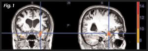 Neuro Emotional Technique (NET) research