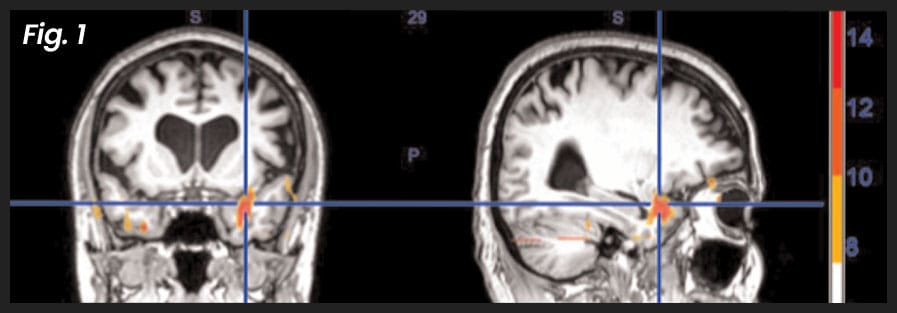 Brain scan during the re-experiencing of trauma before NET treatment