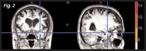 Neuro Emotional Technique (NET) research