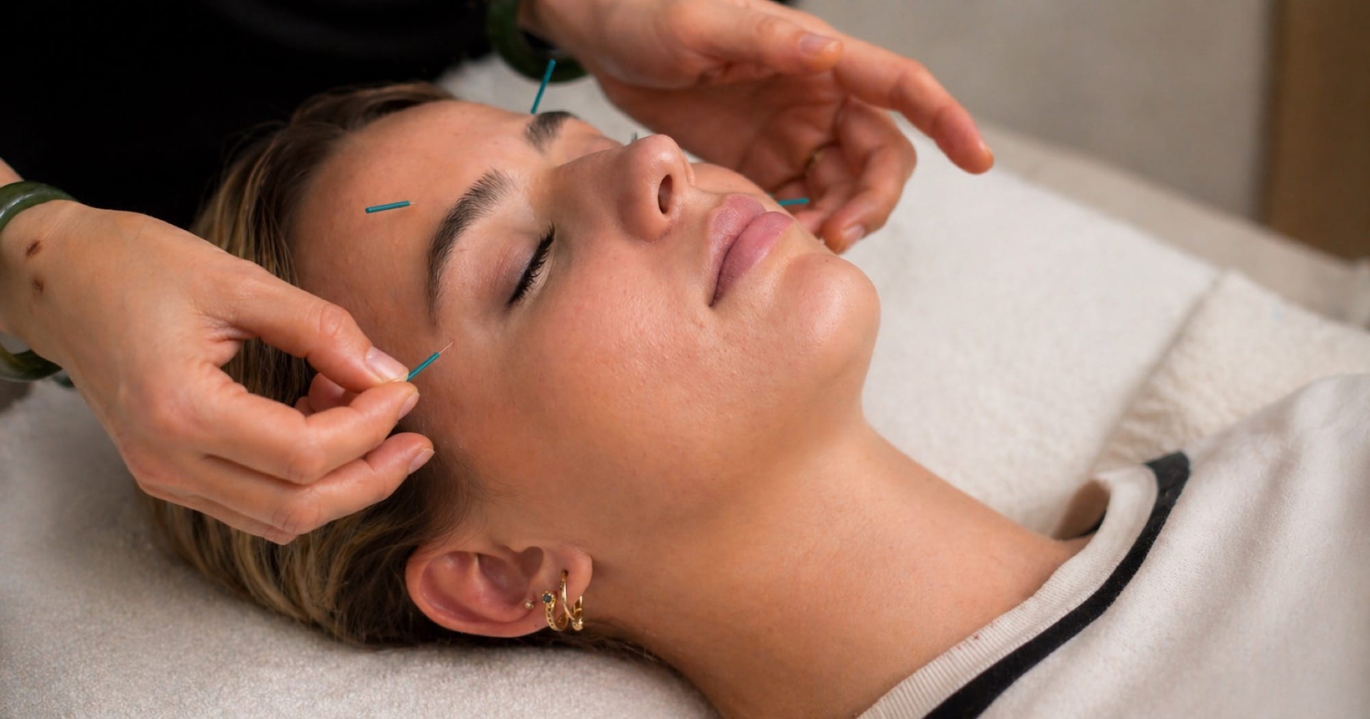 Cosmetic and body acupuncture at Selph