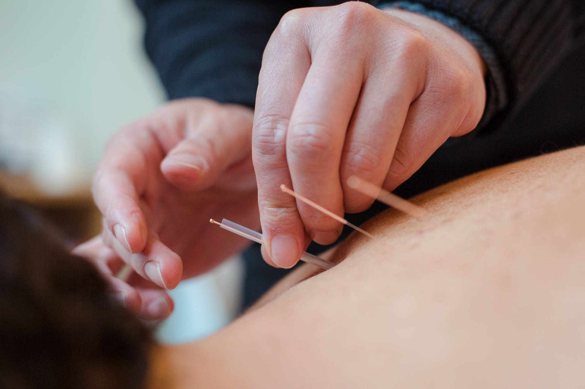 Acupuncture at Selph